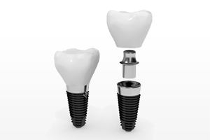 Dental Implants: Understanding Your Options - Dean Glasser, DDS