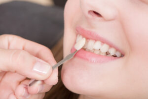 A patient receiving veneers at the dentist’s office